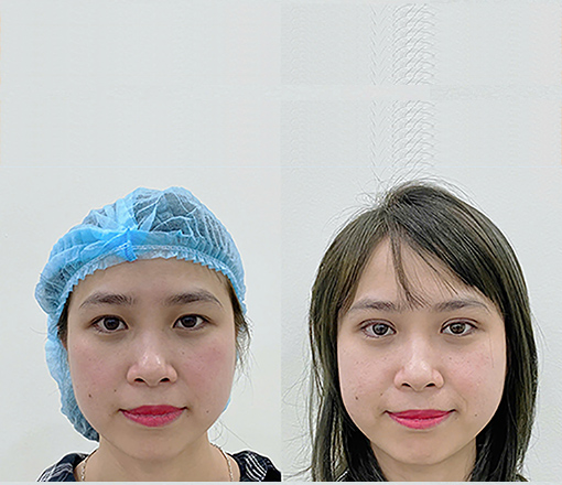 Trước và sau nhấn mí