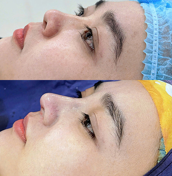 Ảnh trước và sau thực hiện nâng mũi