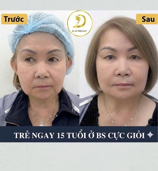 Dịch vụ căng da cổ