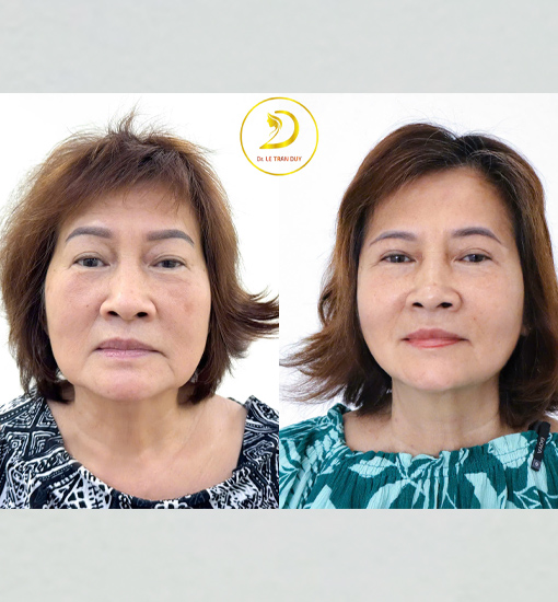 Dịch vụ căng da mặt