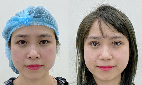 Nhấn mí ở Bác sĩ lê trần duy