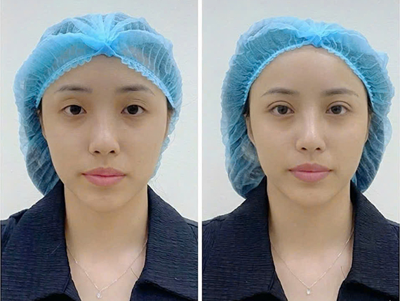 Ảnh trước và sau thực hiện nhấn mí