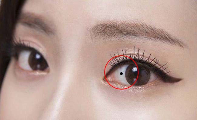 Tẩy nốt ruồi trong lòng trắng mắt