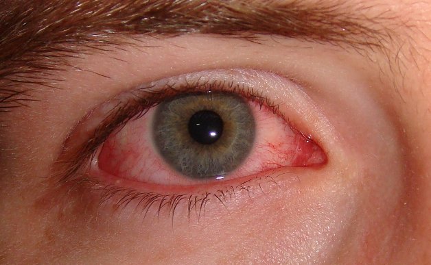 Lòng trắng mắt hiện rõ các mạch máu đỏ