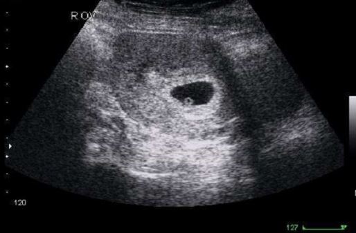Hình ảnh siêu âm thai 4 tuần tuổi