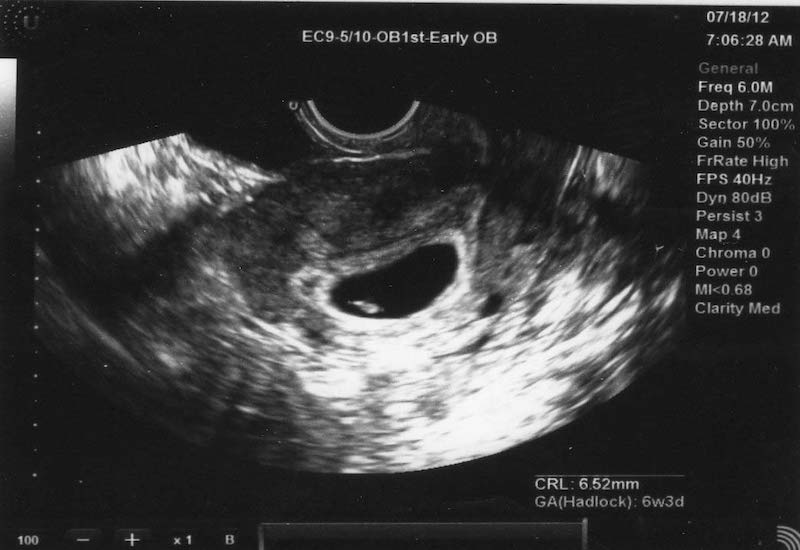 Hình ảnh túi thai 4 tuần tuổi