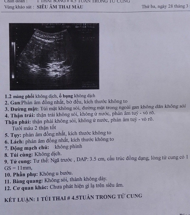 Hình ảnh giấy siêu âm thai 4 tuần