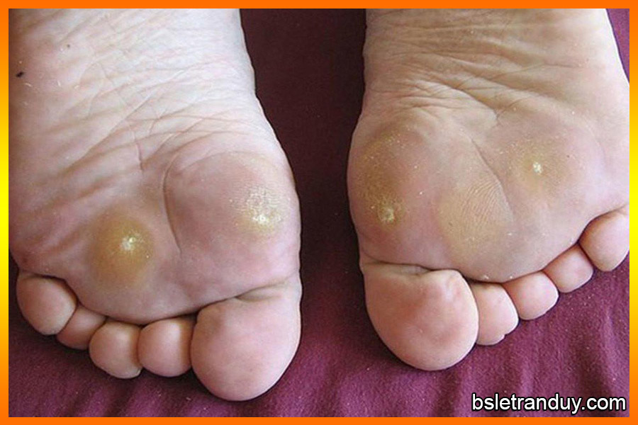 Lòng bàn chân bị nổi cục đau