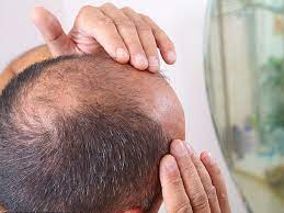 Liệu pháp trị hói đầu di truyền và tóc mỏng