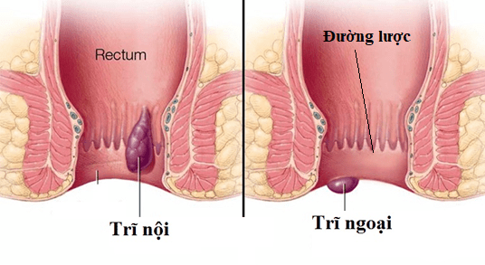 Triệu chứng bệnh trĩ và những biến chứng