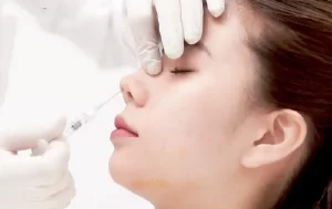 nâng mũi rồi có tiêm filler được không
