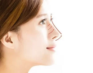 Nâng mũi xong bị khó thở