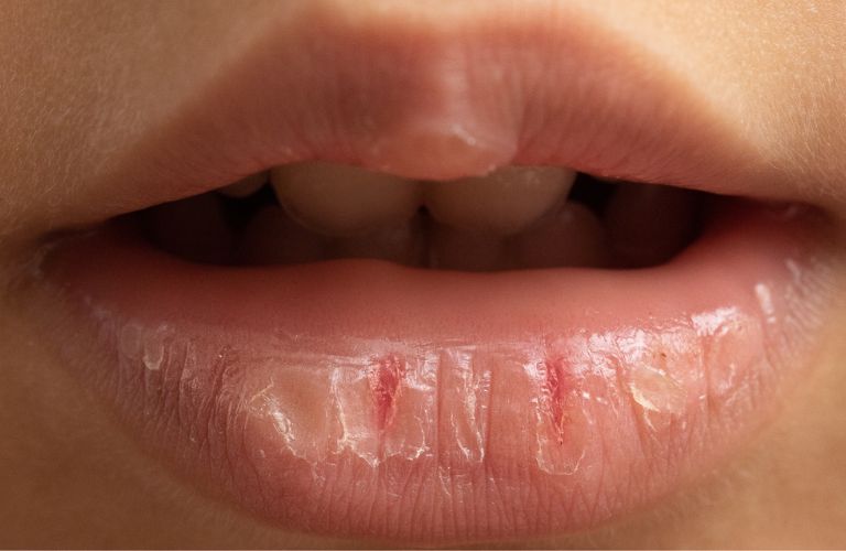 Trường hợp tự ý dùng có thể gây kích ứng, khô môi hoặc bong tróc mạnh