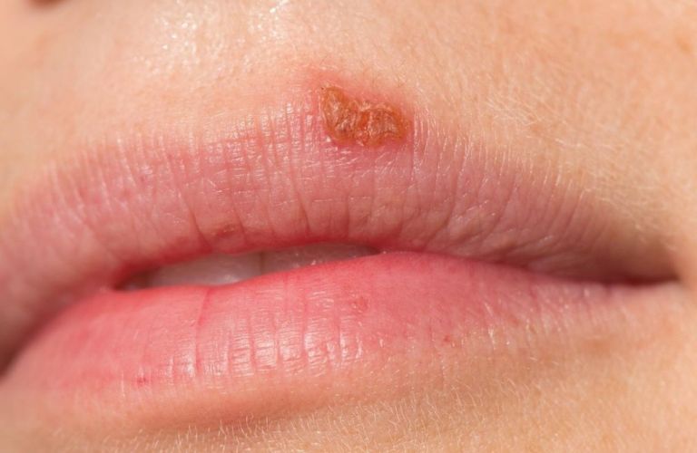 Bôi Acyclovir khi môi xuất hiện mụn nước sau phun