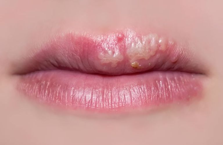 Thời gian dùng thuốc có thể trên 7 ngày đối với trường hợp xuất hiện nhiều mụn nước 