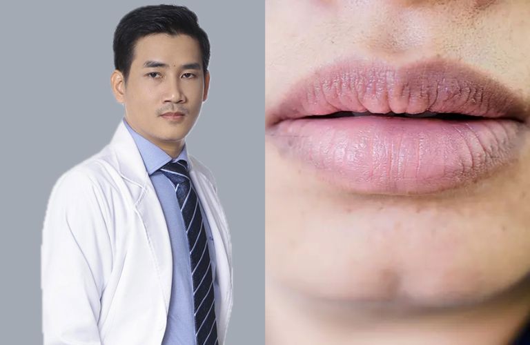 Bác sĩ Lê Trần Duy cải thiện môi thâm nhanh chóng