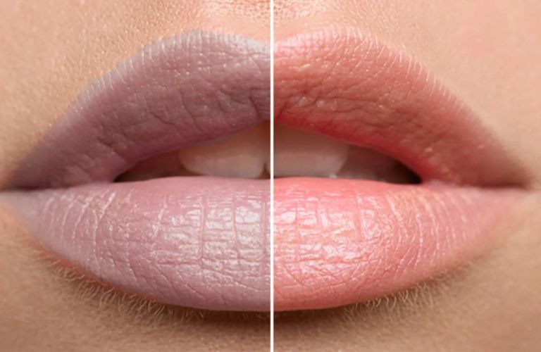 Các phương pháp tại nhà chỉ có thể cải thiện màu môi