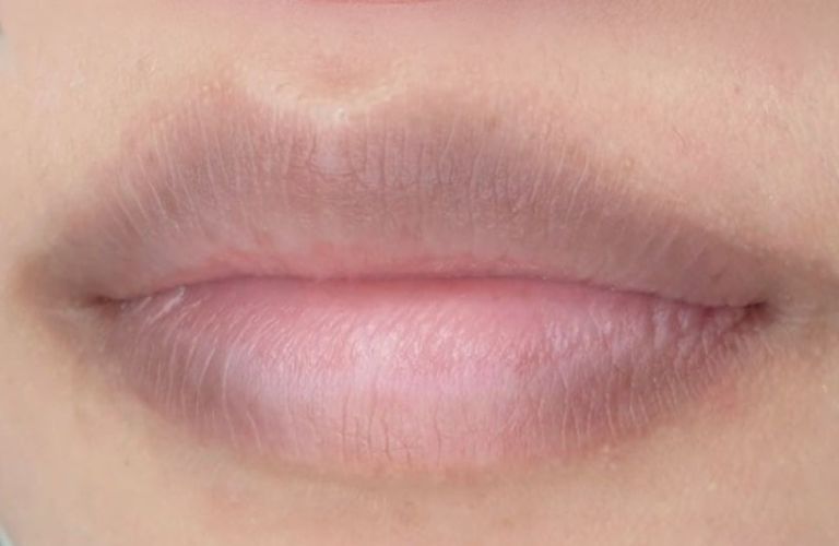 Mép môi bị thâm