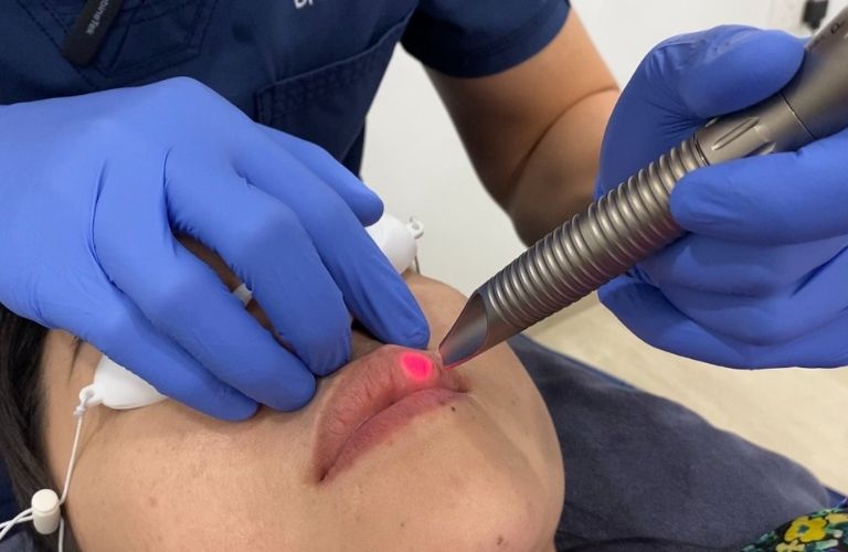 Dùng công nghệ laser trị thâm môi