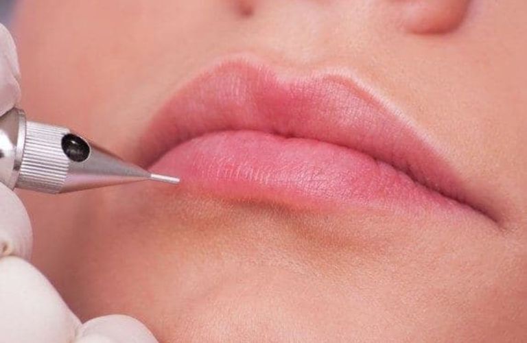 Áp dụng liệu trình trung hòa màu môi nếu viền môi chỉ đậm hơn 1 - 2 tông so với lòng môi