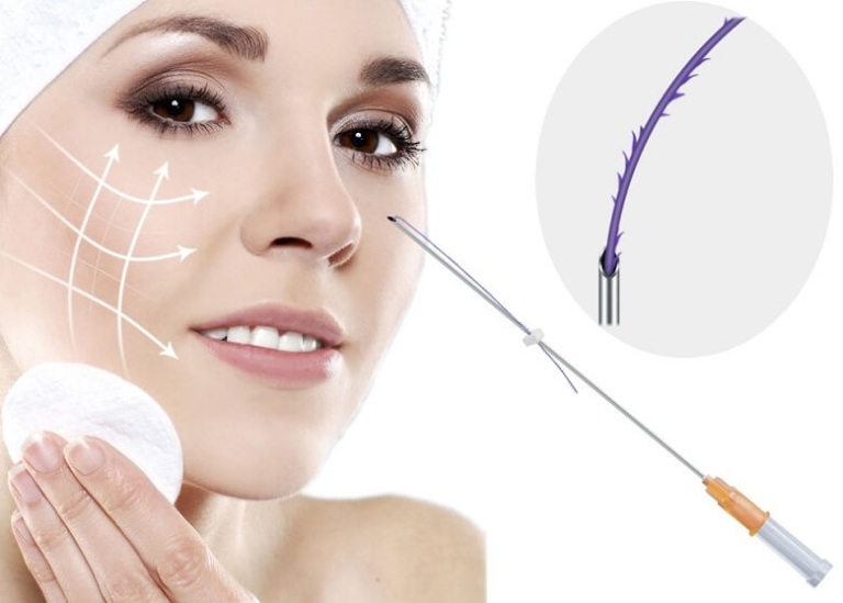 chỉ collagen căng da mặt
