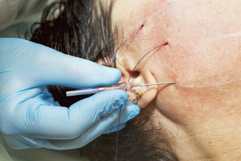 Căng chỉ Collagen có an toàn không