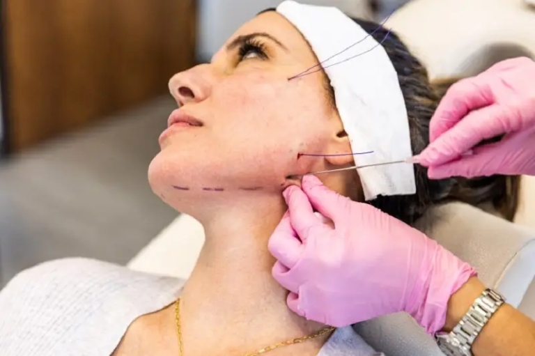 phương pháp căng chỉ Collagen