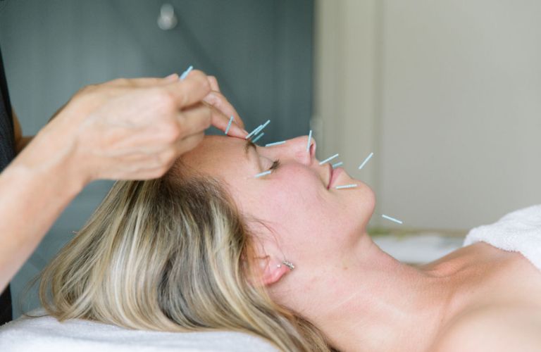 Châm cứu giúp kích thích tuần hoàn máu, cải thiện chức năng cơ mặt