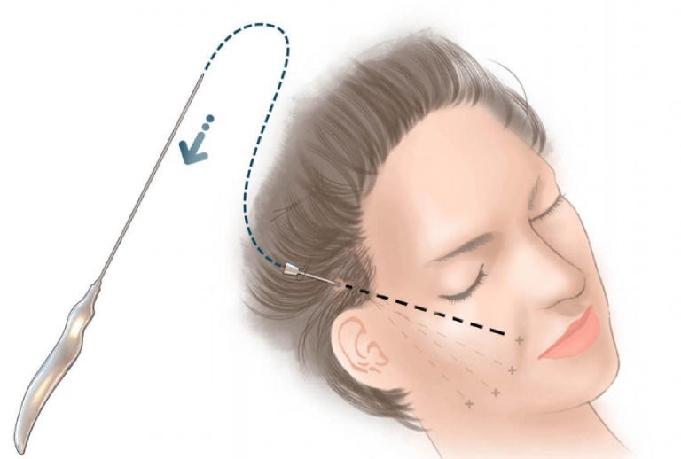 Quy trình căng da mặt bằng chỉ vàng