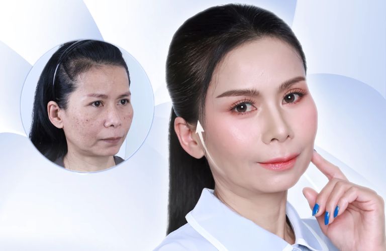 Giảm nếp nhăn và dấu hiệu lão hóa