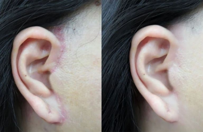 Sẹo lồi sau phẫu thuật căng da mặt