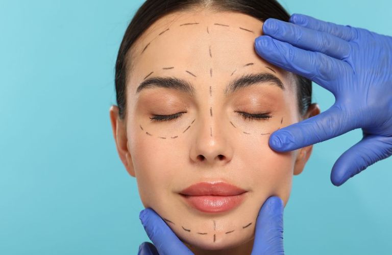 Đo vẽ và đánh dấu trước khi căng da nội soi để đảm bảo độ chính xác