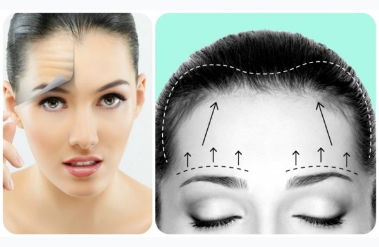 Căng da mặt nội soi không để lại sẹo lớn và ít bị lộ ra ngoài