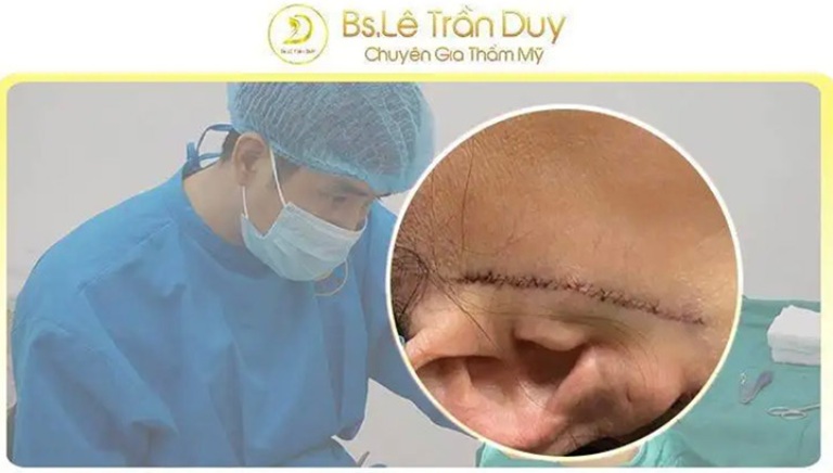 Phẫu thuật căng da mặt xóa rãnh cười