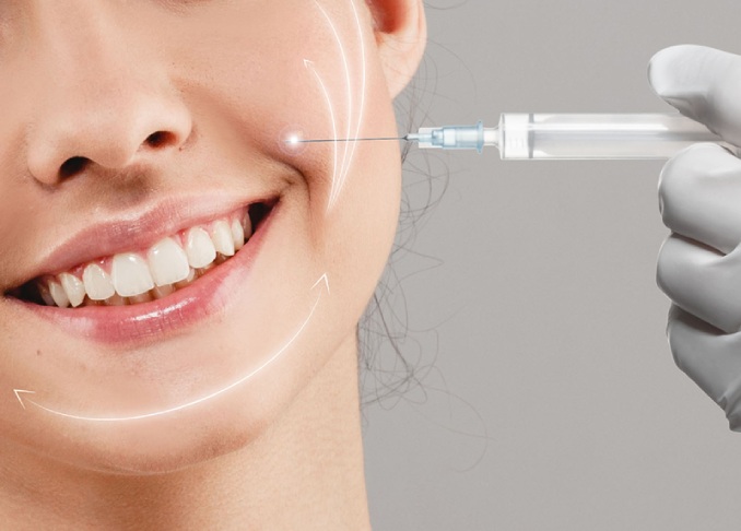 Cách căng da mặt xóa rãnh cười bằng Filler