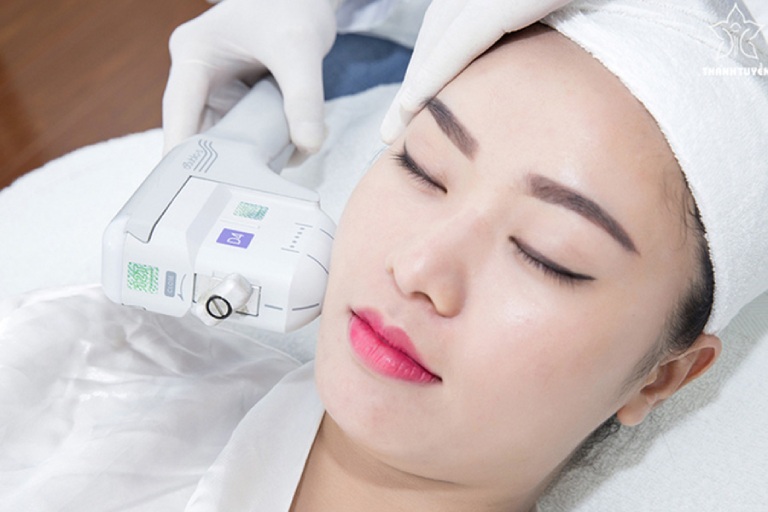 cách xóa rãnh cười căng da mặt bằng laser