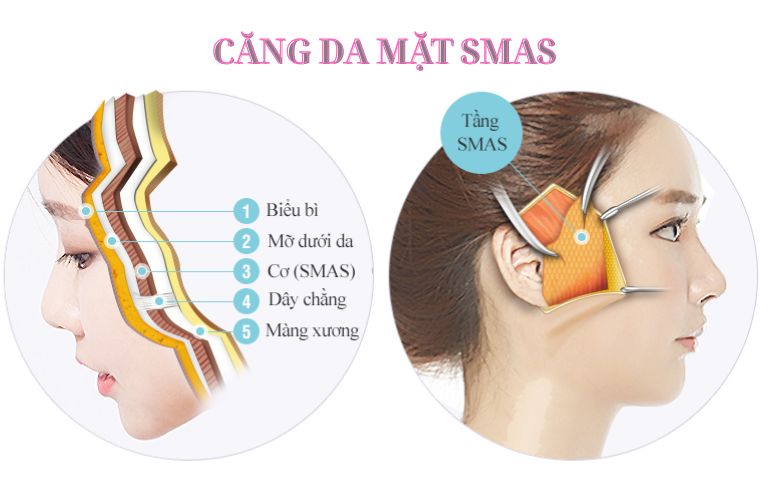 Căng da mặt SMAS