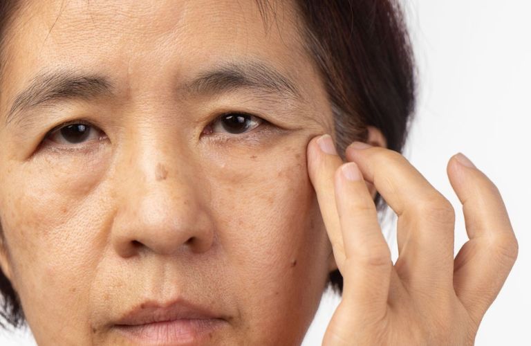 Người có các dấu hiệu lão hóa rõ rệt