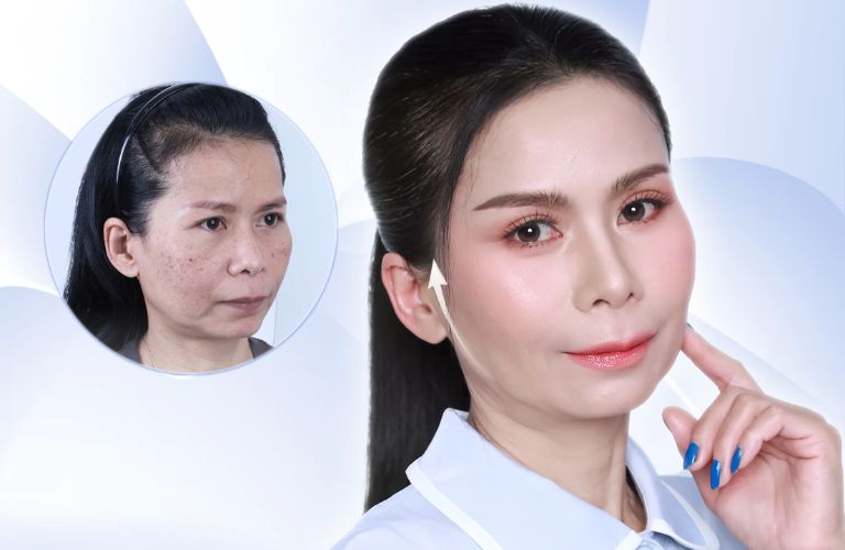 5 địa chỉ căng da mặt tại An Giang uy tín, có BS giỏi