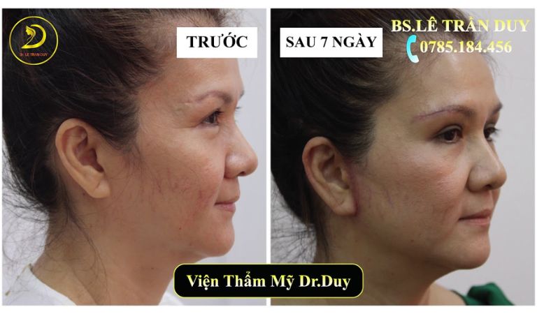 Dịch vụ căng da mặt chuyên nghiệp, an toàn và hiệu quả tại Thẩm Mỹ Viện Galaxy