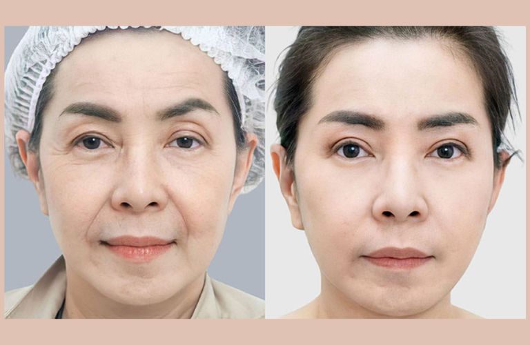 Chăm sóc đúng cách sau khi căng da mặt để đảm bảo hiệu quả dài lâu