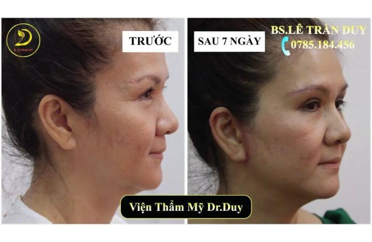 Căng da mặt tại Thẩm mỹ viện Galaxy
