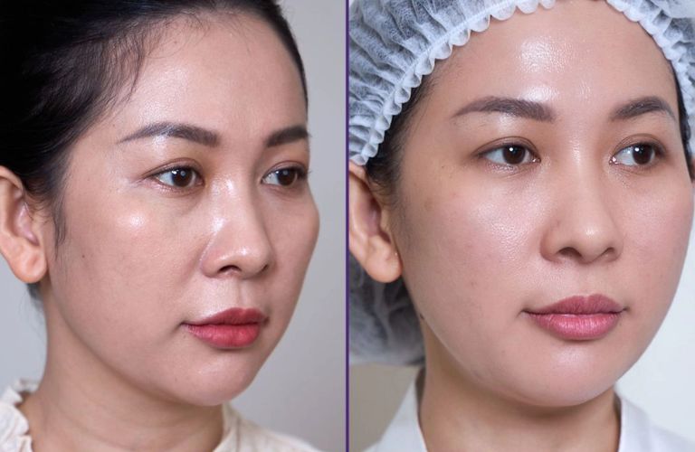 Chăm sóc da đúng cách sau khi căng da mặt để đảm bảo hiệu quả nhanh chóng và dài lâu