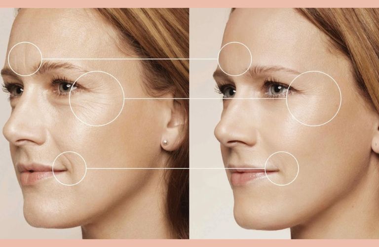 Loại bỏ nếp nhăn và tình trạng chảy xệ