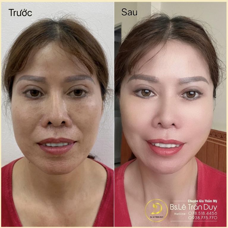 Hình ảnh trước và sau khi căng da mặt tại Thẩm mỹ viện Galaxy