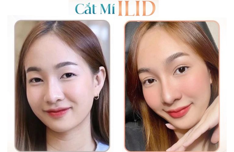 Cắt mí iLid