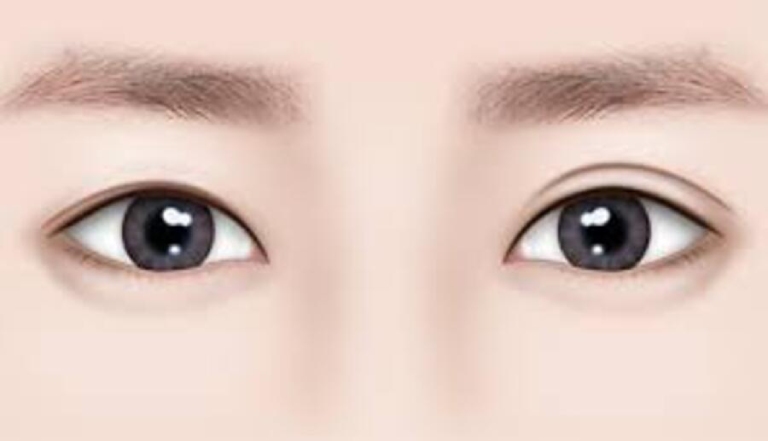 Lợi ích khi cắt mí mắt 1 bên