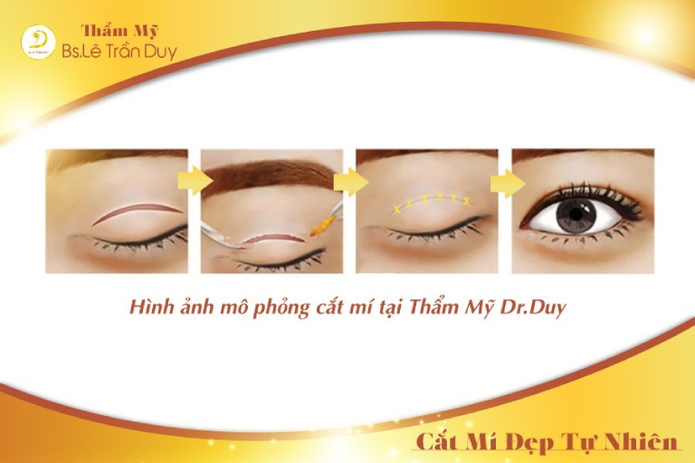 Quy trình cắt mí mắt 1 bên