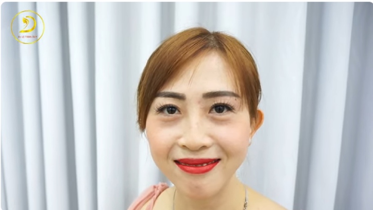 Cắt mí mắt 1 bên tại Thẩm mỹ Bác sĩ Lê Trần Duy