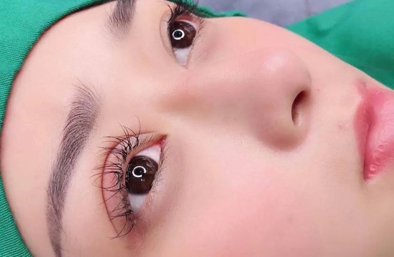 Mí mắt chưa lành hoàn toàn sau 2 tuần cắt mí